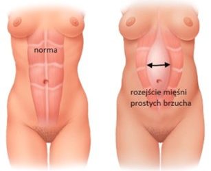 Rozstęp mięśni prostych brzucha